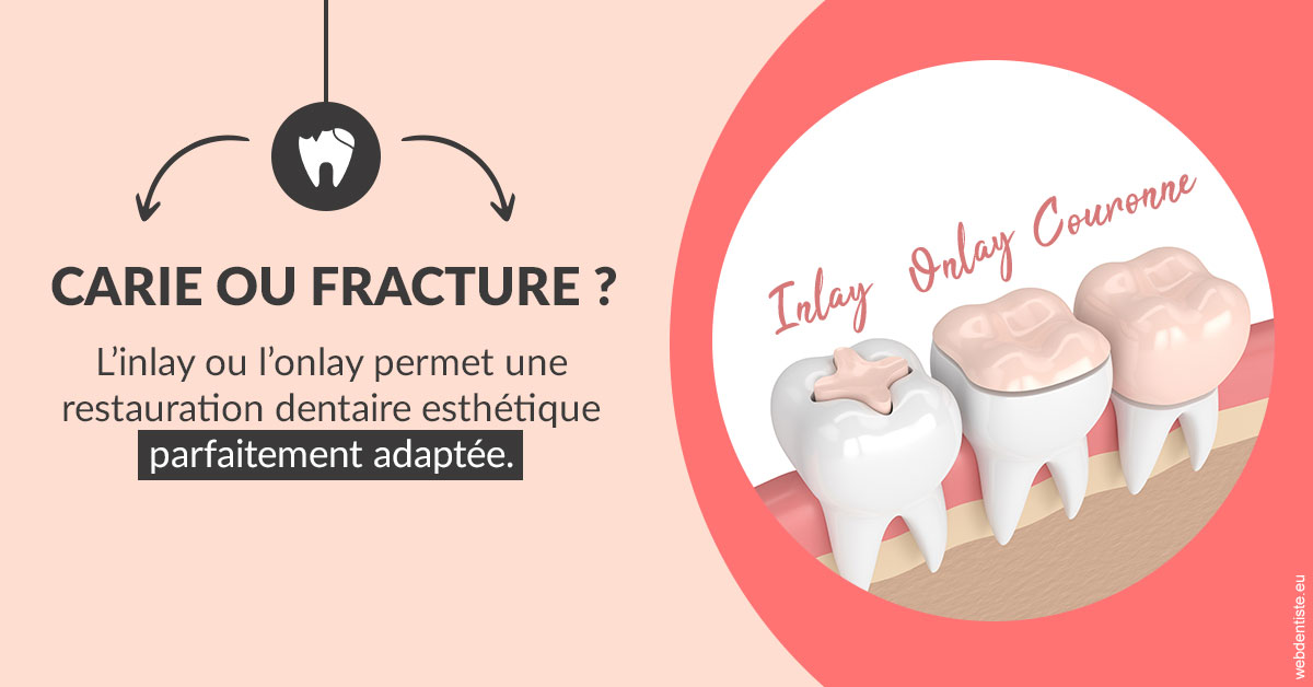 https://selarl-du-docteur-franck-wattinne.chirurgiens-dentistes.fr/T2 2023 - Carie ou fracture 2