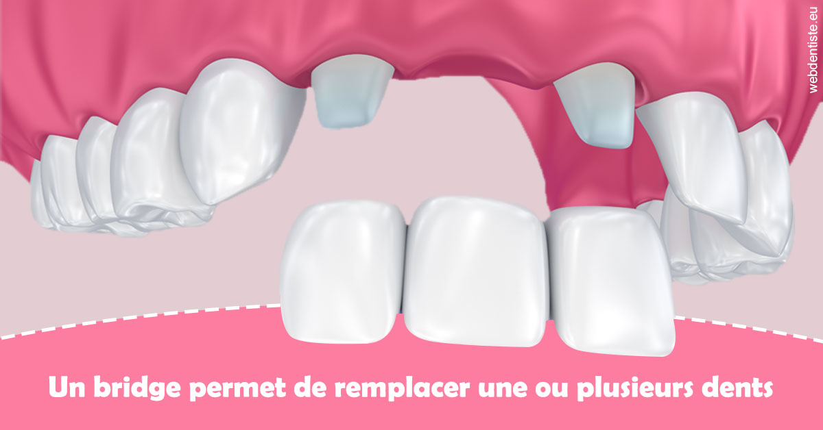 https://selarl-du-docteur-franck-wattinne.chirurgiens-dentistes.fr/Bridge remplacer dents 2