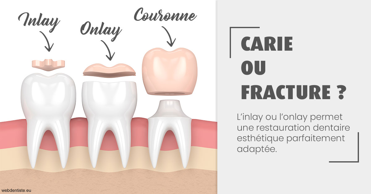 https://selarl-du-docteur-franck-wattinne.chirurgiens-dentistes.fr/T2 2023 - Carie ou fracture 1