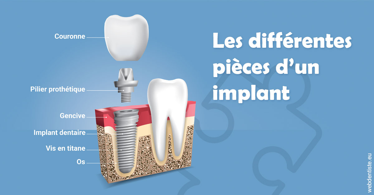 https://selarl-du-docteur-franck-wattinne.chirurgiens-dentistes.fr/Les différentes pièces d’un implant 1
